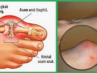 Cara Mengobati Asam Urat Dengan Menggunakan produk NASA
