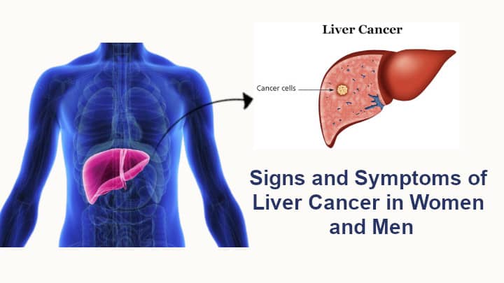 Signs-and-Symptoms-of-Liver-Cancer-in-Women-and-Men