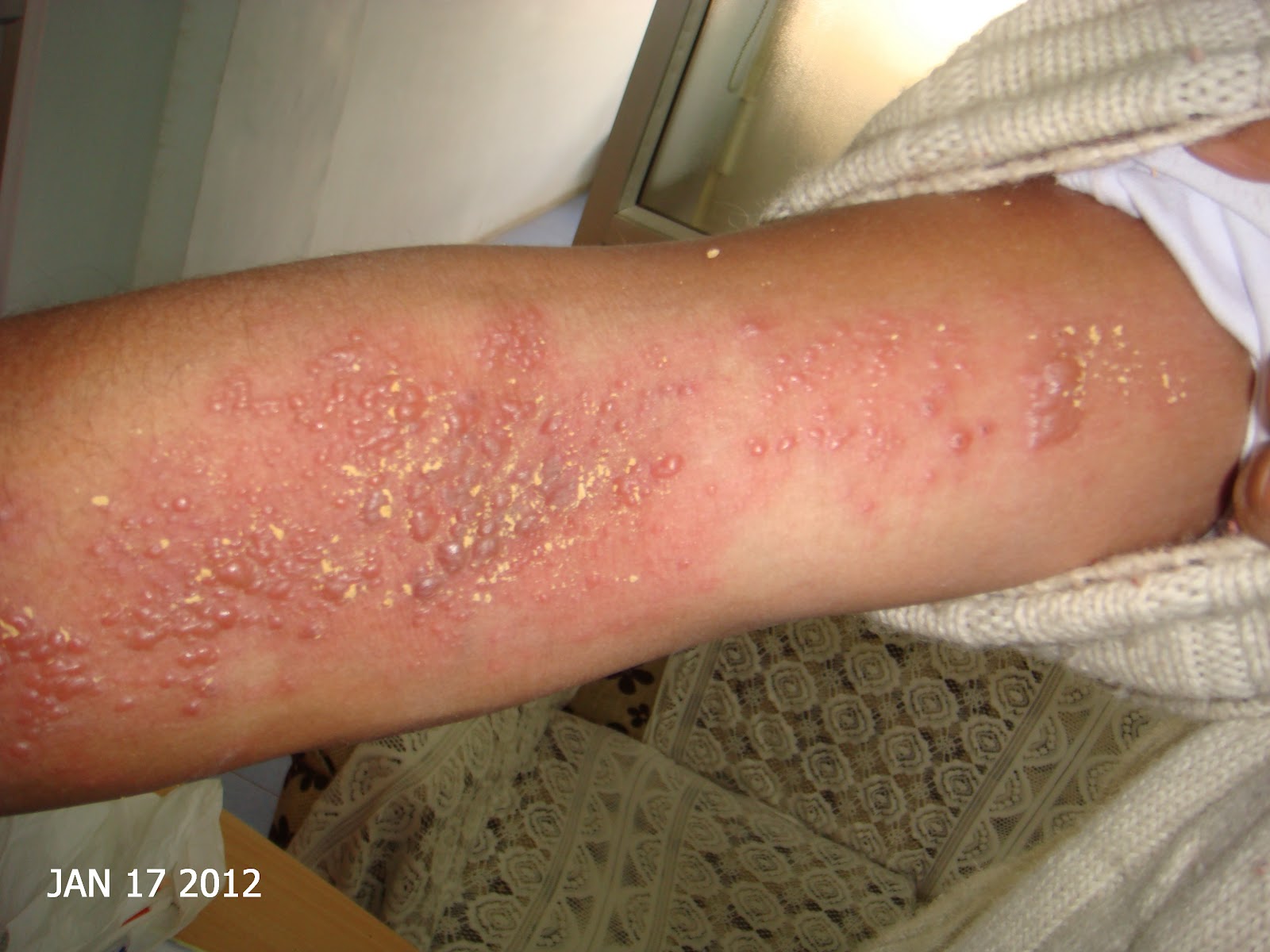 Herpes Zoster Treatment Homeopathy : What Is Eczema Herpeticum Herpes And Dermatitis Disorder