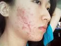 Tips Cara Merawat Wajah Berjerawat