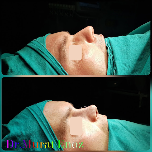 Rhinoplasty in men Istanbul