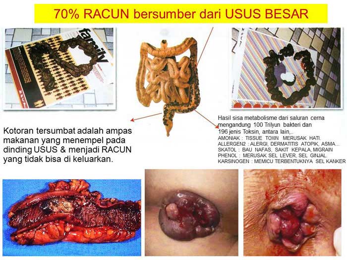 Kepentingan Cuci Usus untuk Badan Sihat  Jelitawan 