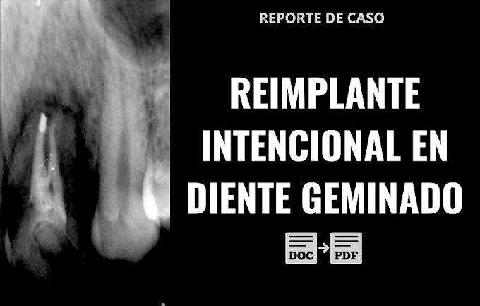 PDF: Reimplante intencional en diente geminado con lesión endoperio tipo IV