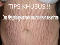 Cara Menghilangkan Bekas Stretch Mark Setelah Melahirkan