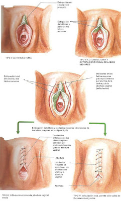 Infografía donde se muestran los diferentes tipos de ablación genital femenina. En breve explico.