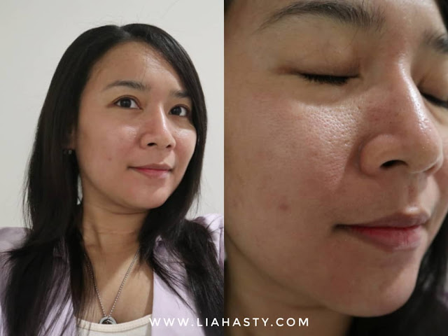 Rawatan Brightening & Open Pore Part 2 di Klinik Pakar Dr Ko Juru