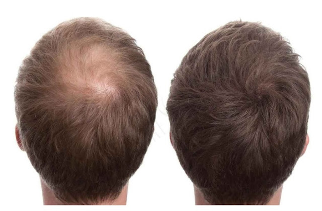 cover hair loss with hair building fibres