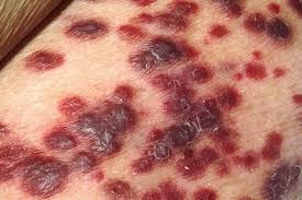 Bahaya kurap kanker kulit