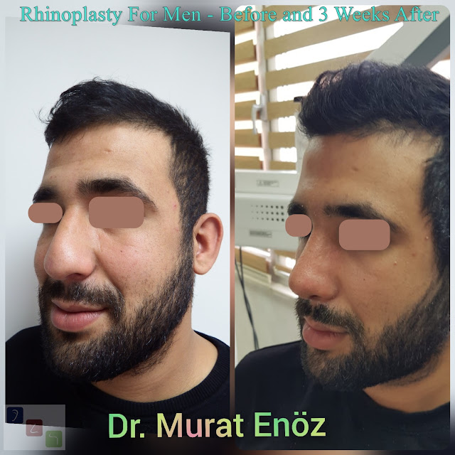 Rhinoplasty For Men - Before and 3 Weeks After - Male Nose Job Turkey