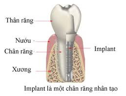 cấu tạo của implant