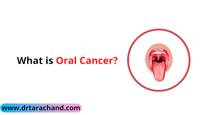 What is Oral Cancer by Dr. Tara Chand Gupta