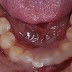 Nguyên nhân gây mất răng cần đề phòng