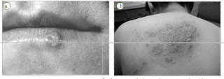 Virus  herpes dapat menyerang beberapa bagian tubuh, di antaranya bagian (a) mulut dan (b) punggung.