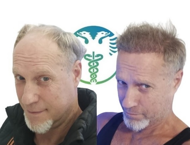 Uomo di 53 anni prima e dopo il trapianto di capelli a Tirana, metodo: FUE Zaffiro,innesti impiantati: 4500