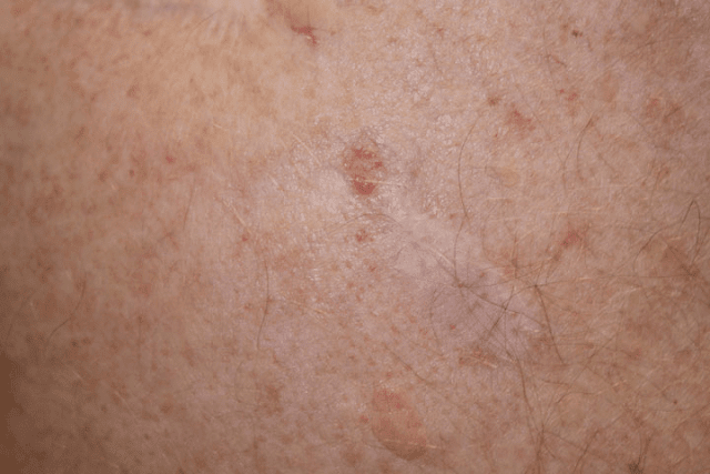 skin cancer-symptoms-pain