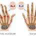Artritis : Bikin Hidup Makin Meringis
