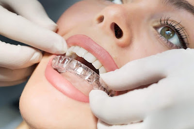 Quy trình niềng răng invisalign như thế nào? 3