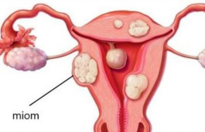  untuk menyembuhkan penyakit tidak diragukan lagi Daun Binahong Sembuhkan Siti dari Mioma (Cerita)