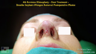 Breathe Implant à Wengen,4. revision nose job, Dent After Rhinoplasty, Complicated 4th Revision Rhinoplasty, Nasal contour irregularities, Postoperative dent issues, Revision rhinoplasty challenges, Rhinoplasty side effects, Nasal structural integrity,