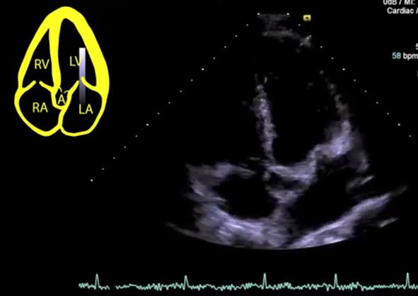 From A4C , Apical 5 chamber view is obtained by directing beam more anteriorly towards the AV which is anterior structure within the thorax