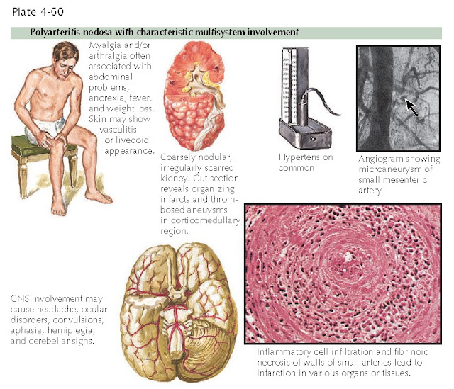 Polyarteritis nodosa with characteristic multisystem involvement