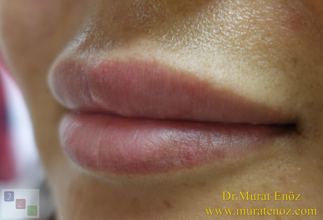 Risks of lip filler - Side effects or risks of lip filler injection - Best filler material - Risks of silicon-containing fillers - Lip augmentation with filler in Istanbul - Shaping lips with fillers - Lip enhancement with fillers in İstanbul, Turkey - Non-surgical lip augmentation - Lip augmentation and enhancement with filler - Lip filler - Lip augmentation in Istanbul - Lip augmentation (hyaluronic acid fillers) in Istanbul