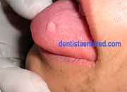 <Img src ="fibro-papiloma- de-lengua.jpg" width = "180" height "130" border = "0" alt = "Bulto benigno en la lengua">