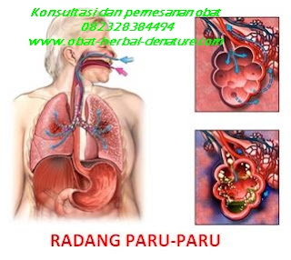 obat batuk paru,obat paru paru basah,obat batuk menahun,obat batuk TBC,obat batuk akibat rokok,obat batuk paru paru,obat paru paru bocor,obat batuk berlendir,obat batuk berdarah