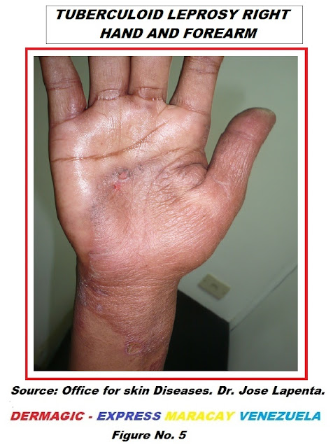 Bordeline tuberculoid leprosy, right hand, forearm