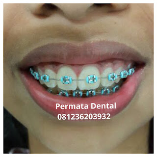 gambar foto behel bracket kawat gigi sebelum dan sesudah perawatan untuk memperbaiki merapikan gigi gingsul gigi miring renggang tonggos berantakan keluar masuk jarang diastema maju mundur tidak rapi tidak beraturan bali denpasar banyuwangi jember tidak rata kocar kacir