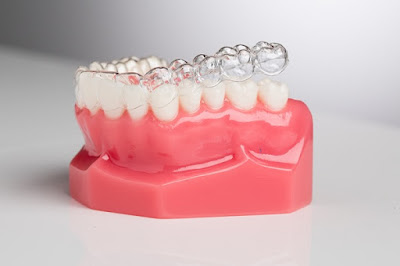 Lợi ích niềng răng không mắc cài 3D Clear 