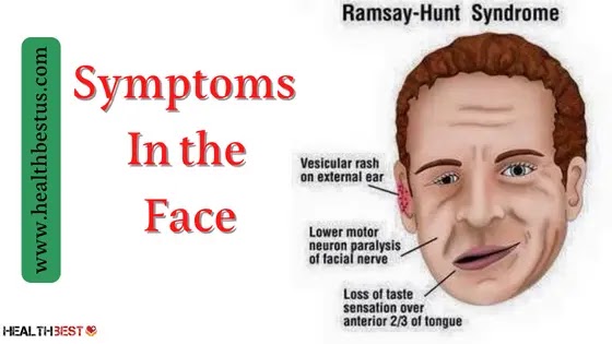 Symptoms of Ramsey Hunt
