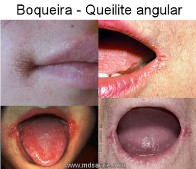 Fotos de boqueira - Queilite angular.