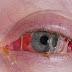Conjunctivitis | Pink Eye / கான்ஜுன்க்டிவிடிஸ் | இளஞ்சிவப்பு கண்