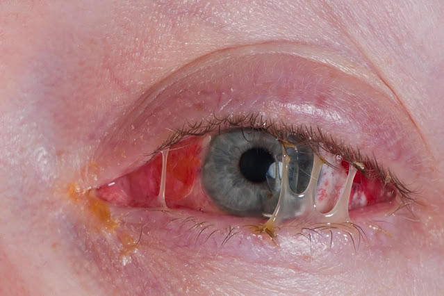 Conjunctivitis | Pink Eye