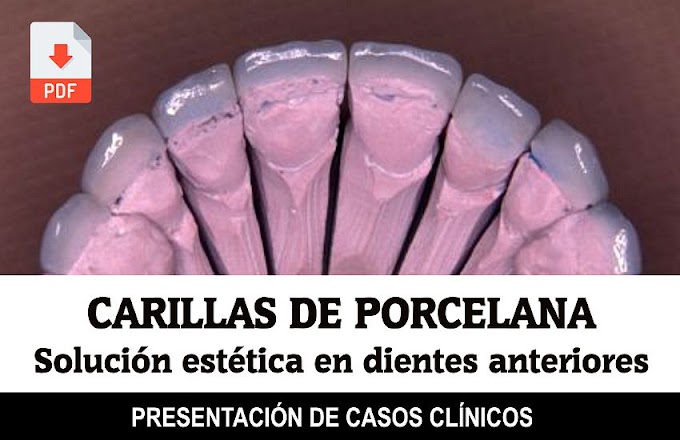 PDF: Carillas de Porcelana como solución estética en dientes anteriores: informe de doce casos