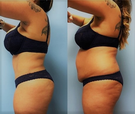 tummy tuck cost - tummy tuck before and after