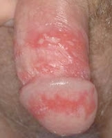 herpes-genitalis