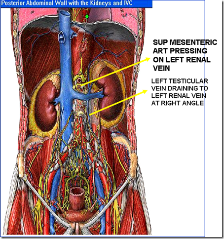 Horseshoe Kidney Complications. pancrease amp; left kidney