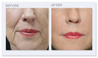 before and after wrinkle treatment