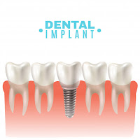 dental implant in gurgaon