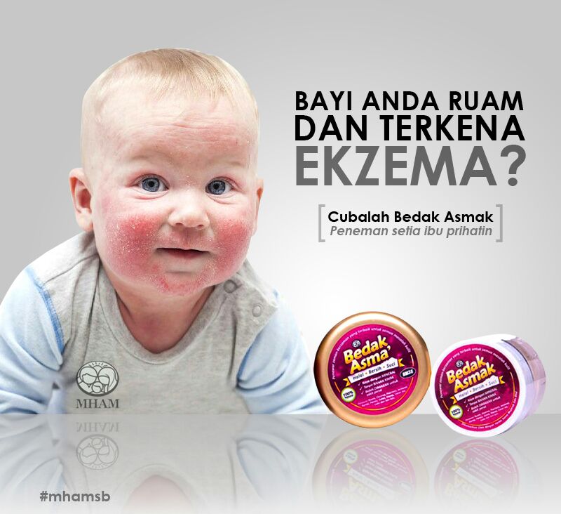 Bedak Asmak Alternatif Penyakit Kulit Ekzema  Best 