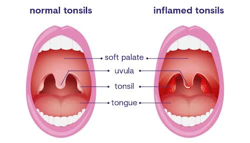 Tonsil dan Uvula