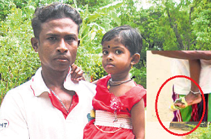 4-Year-Old Girl Cobra bite in kurunagala