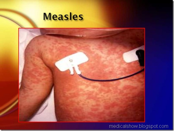 measles