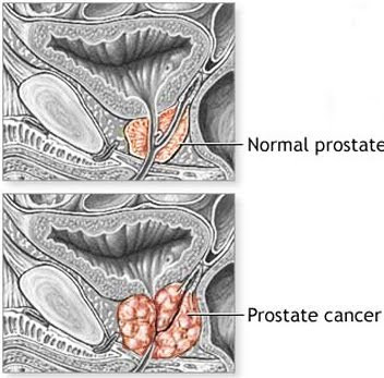 prostate cancer diet