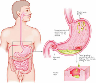 Obat Maag Alami Herbal