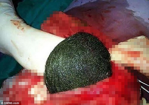 See Giant Hairball Removed From a Woman's Stomach After Surgery (Graphic Photos)