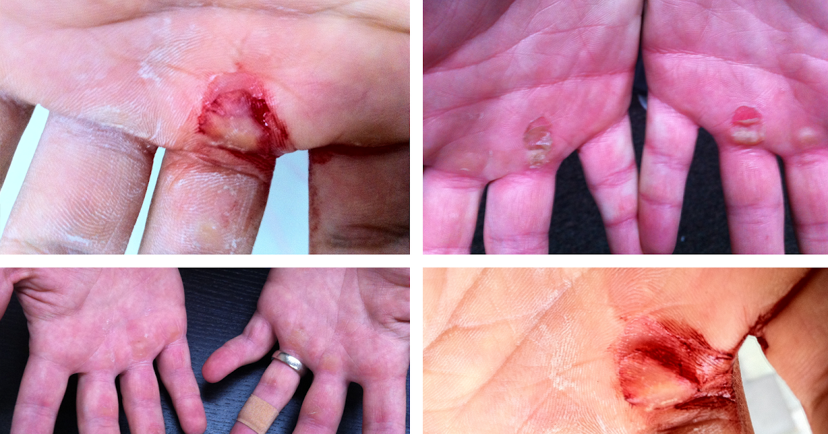 Prevent Your Calluses from hurting while Doing Pull-Ups by Callus