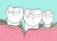 <Img src ="Esquema-bolsa-periodontal.jpg" width = "200" height "144" border = "0" alt = "Dibujo de una bolsa periodontal.">